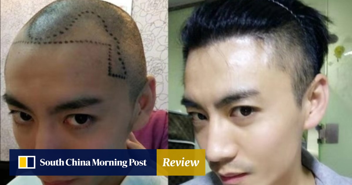 Millennial Chinese Men Going Bald Younger Getting Hair