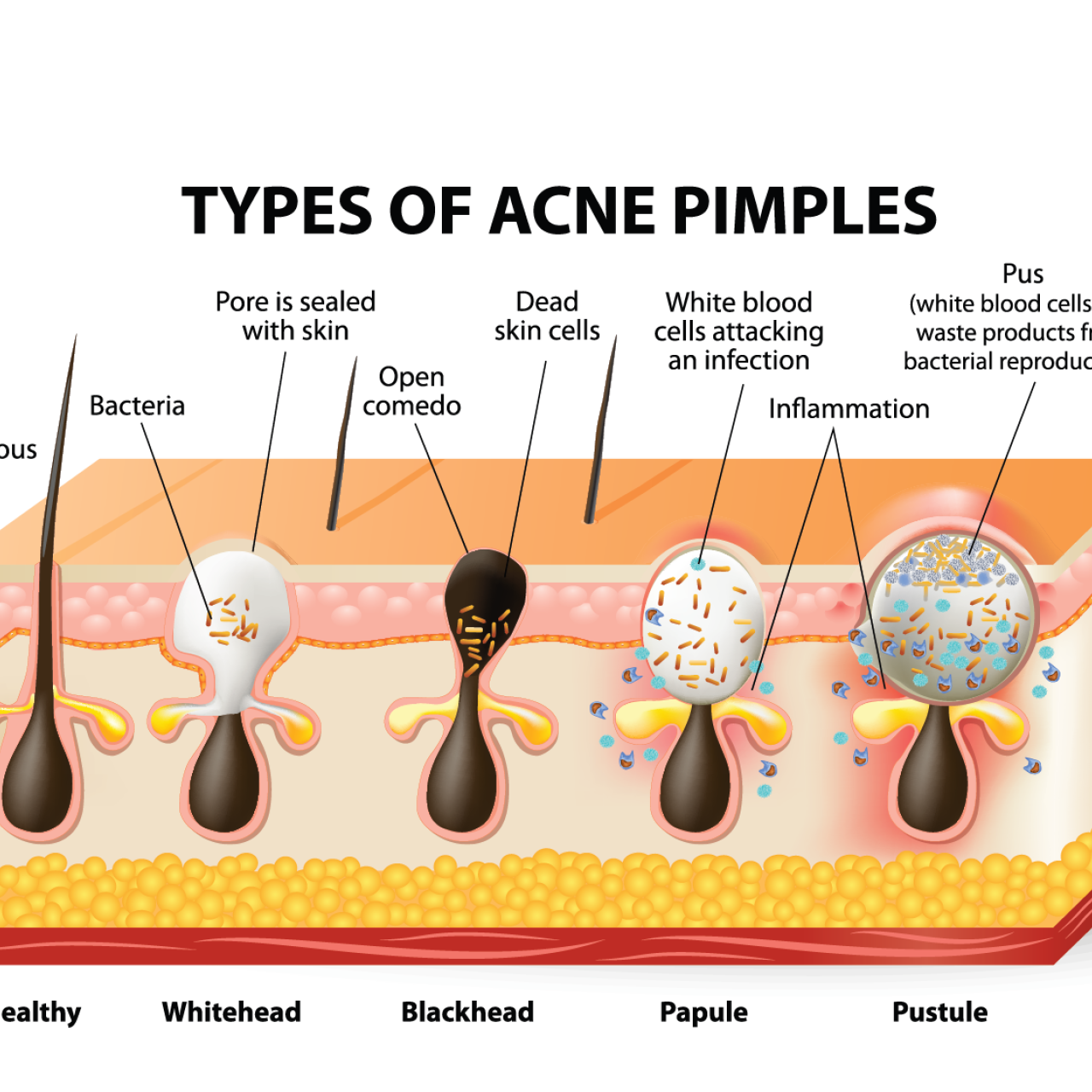 how to get core of pimple out