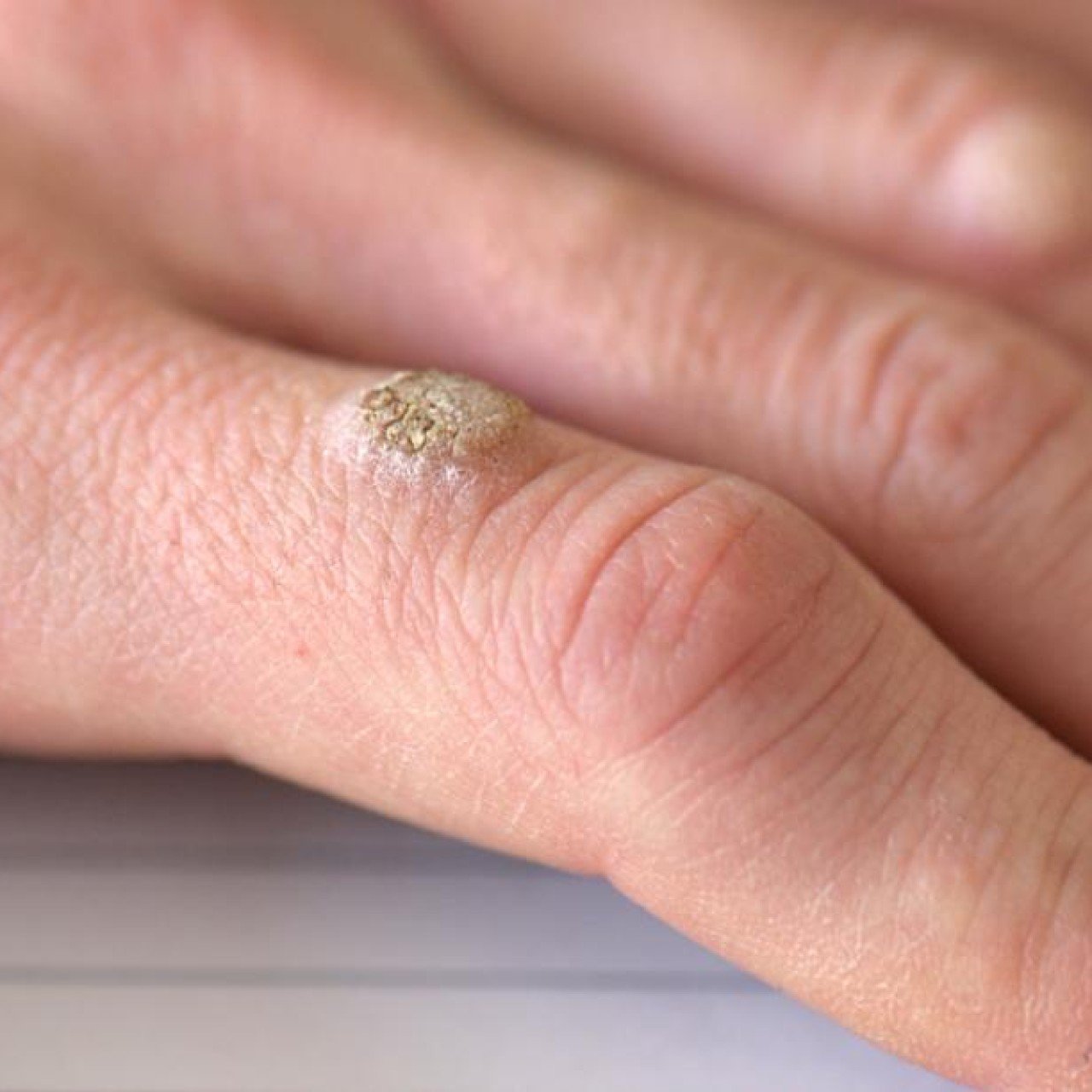 Share 149+ clear nail polish wart removal best songngunhatanh.edu.vn