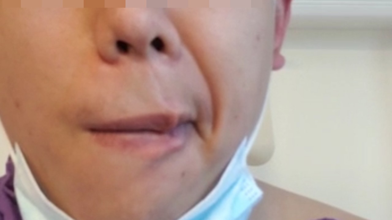 Young Hong Kong Man Describes Ordeal Of Facial Paralysis After Receiving Covid 19 Vaccine South China Morning Post