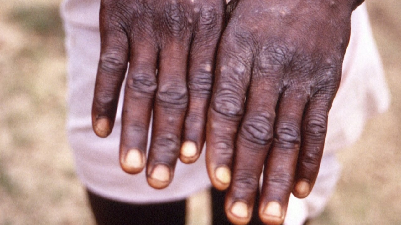 Italian man diagnosed with Covid-19, monkeypox and HIV in a single day