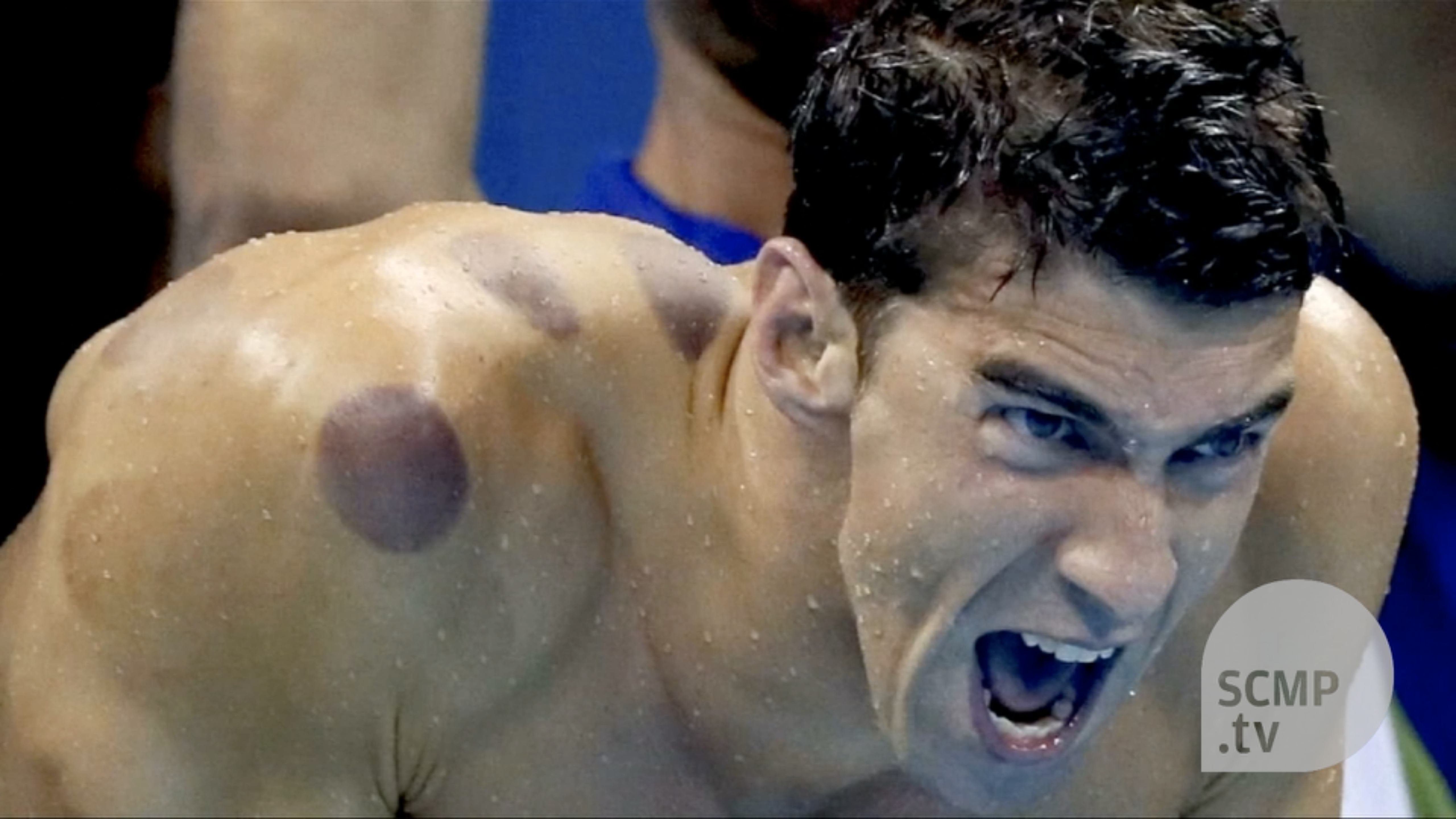 Cupping therapy makes the rounds at the Olympics